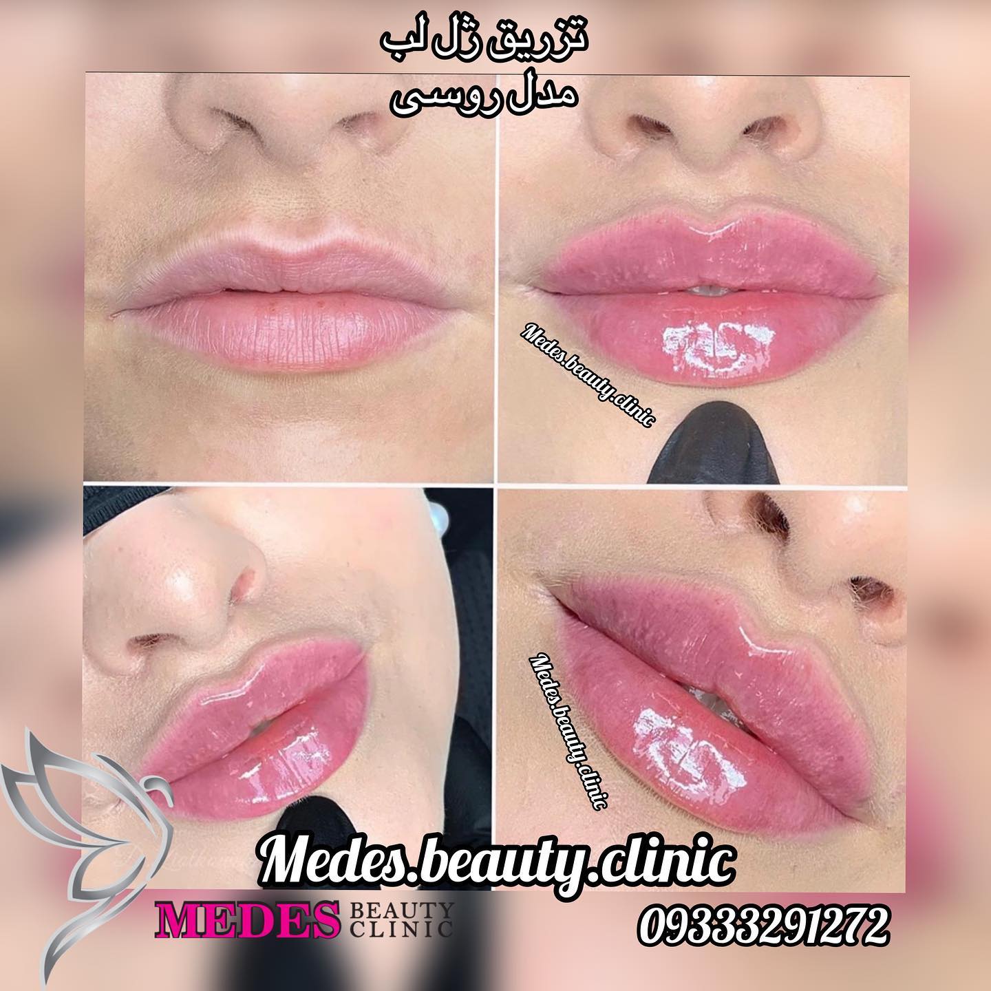 گالری تزریق ژل لب